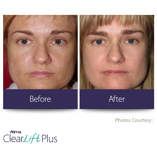 Clearlift Skin Before and After