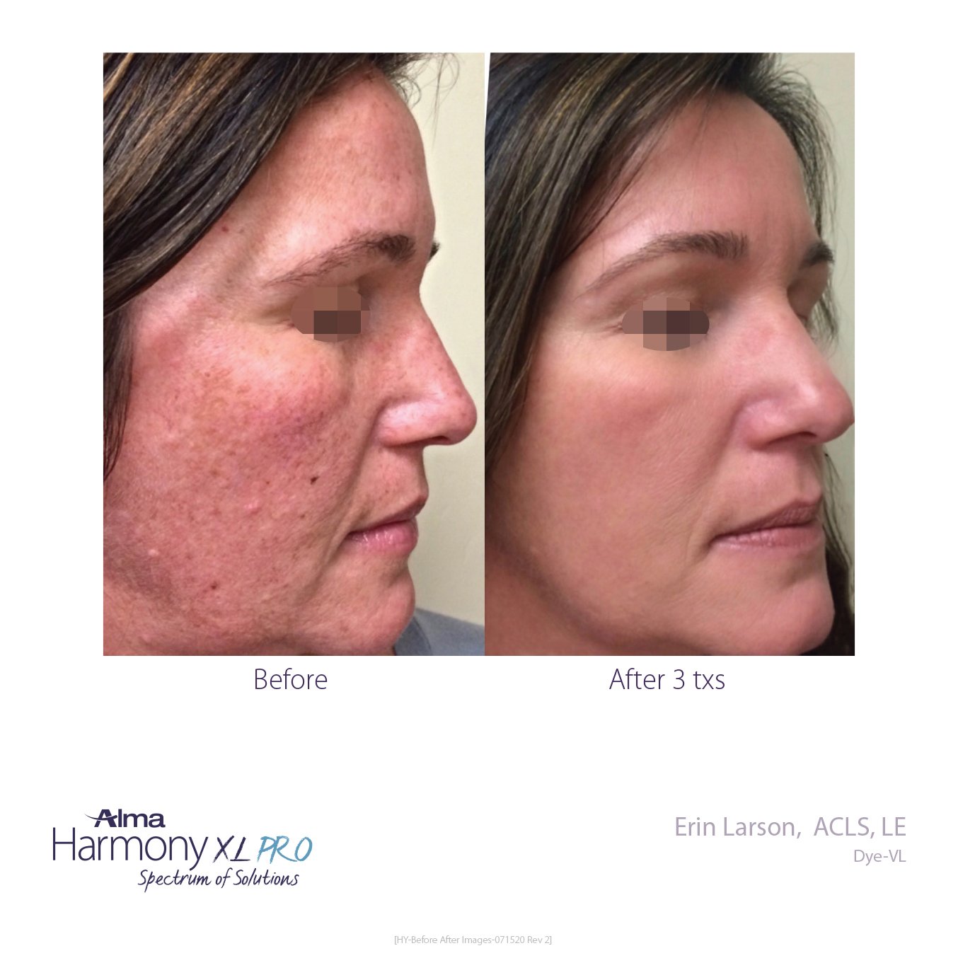 Clear Skin before and after at Rajeunir Esthetique in Reading, PA