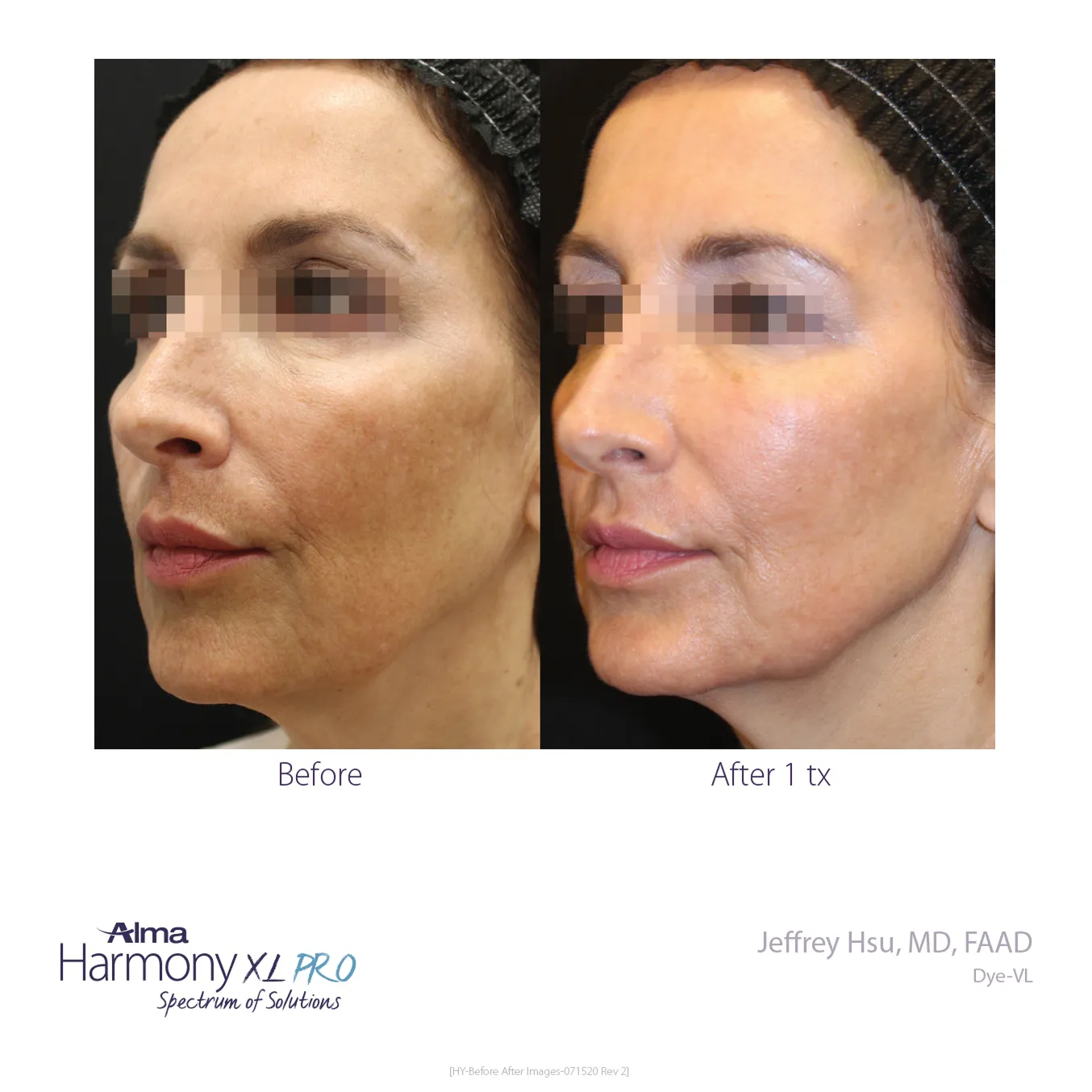 Before & after for skincare treatment at Rajeunir Esthetique in Reading, PA
