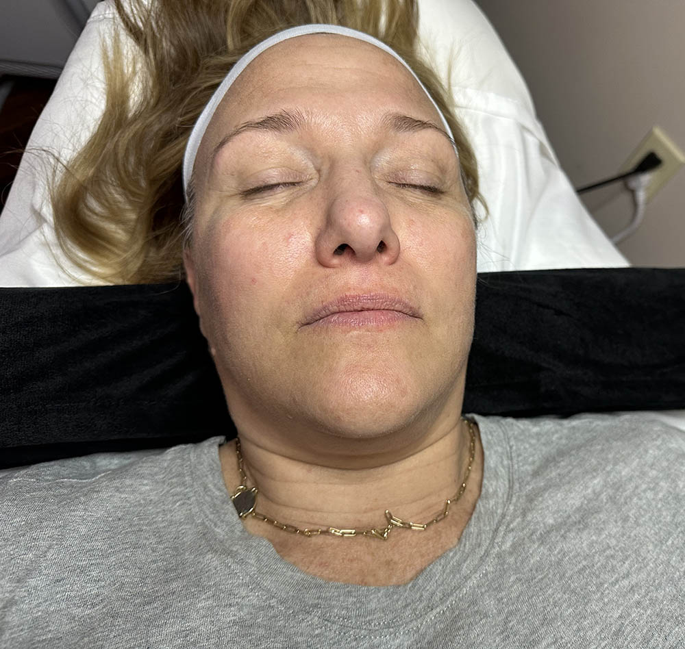 Before a premium hydrafacial treatment at Rajeunir Esthetique.