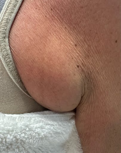 Bra Fat Reduction on Dr. Samantha Wesner - Ultrasculpt Fat Contouring