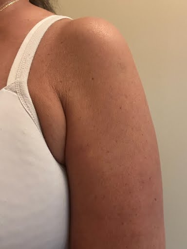 After Bra Fat Reduction - Ultrasculpt Fat Contouring Rajeunir Esthetique
