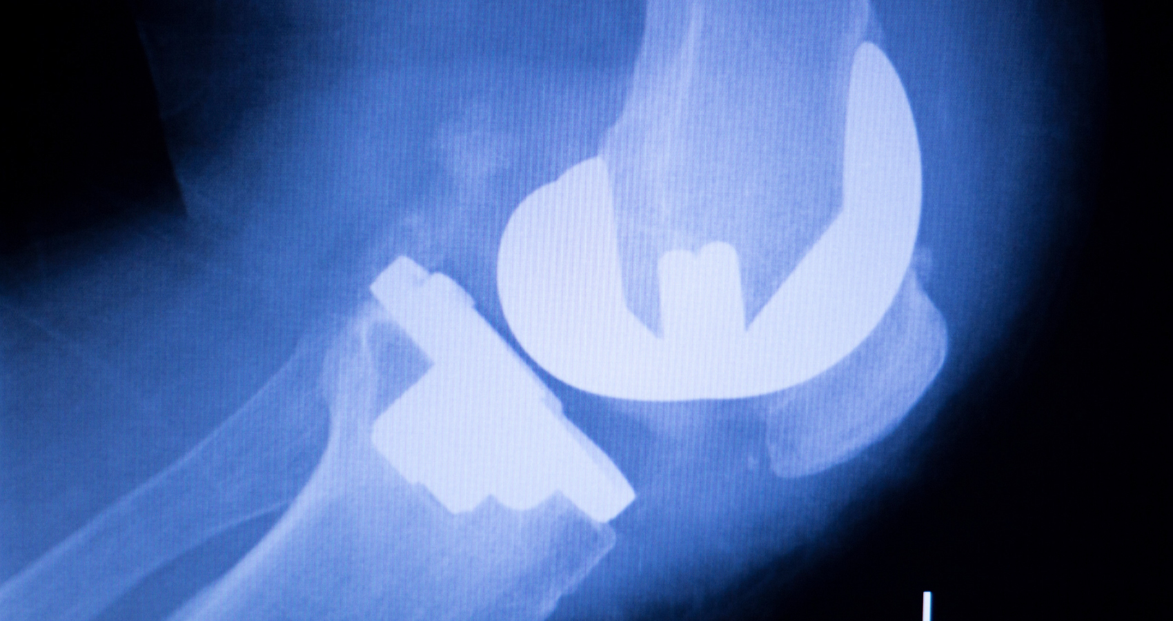 ERP Integration: Most Never Get It Right (What Even The Best Leaders Miss When Optimizing Medical Device Field Operations)