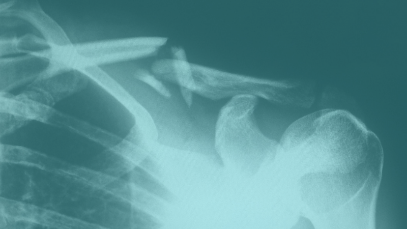 Solving Medical Device Field Inventory Challenges (Consignment Management etc...)