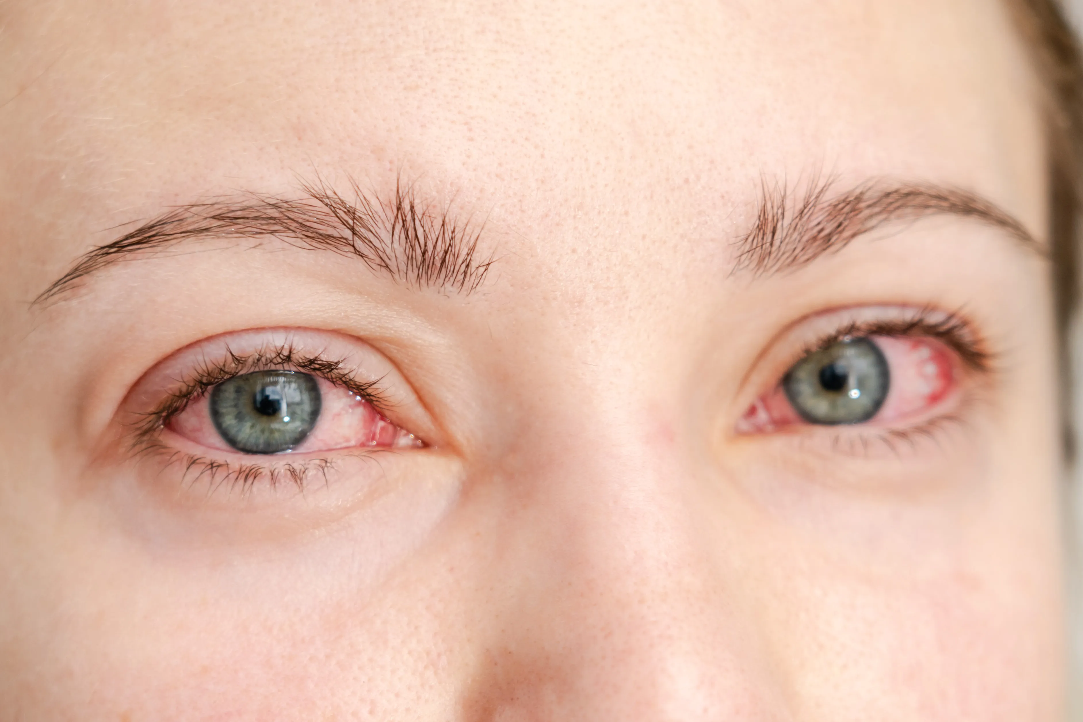 Close-up of irritated, red eyes with green-blue irises