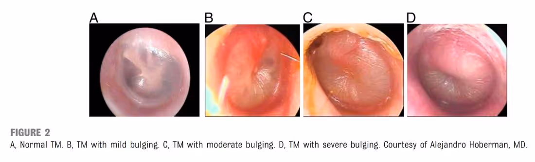 Four otoscopic photographs of tympanic membranes showing a normal TM and progressively more severe bulging.