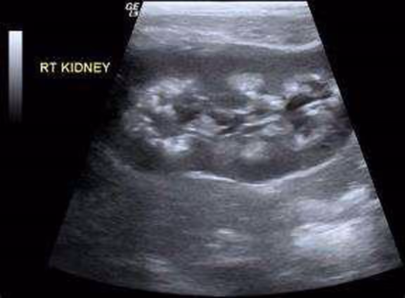 Renal ultrasound demonstrating nephrocalcinosis