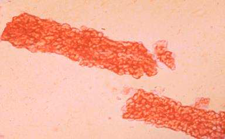 Red blood cell casts on urine microscopy, indicating glomerular hematuria