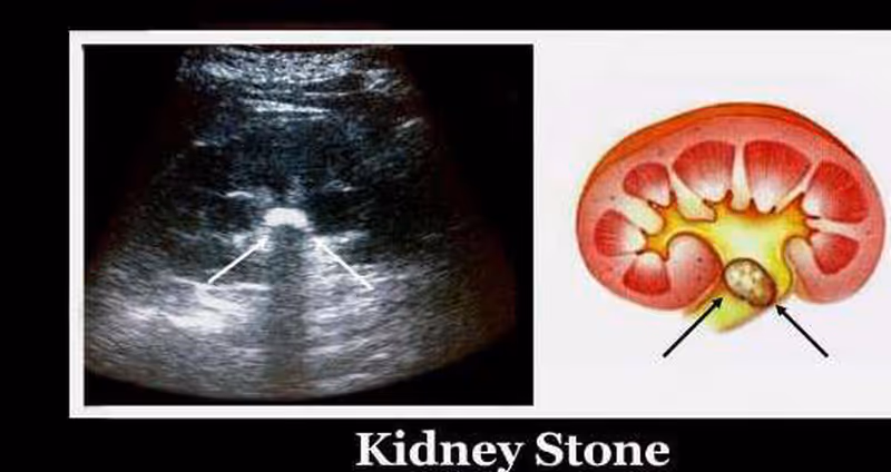 Renal ultrasound demonstrating a kidney stone with acoustic shadowing