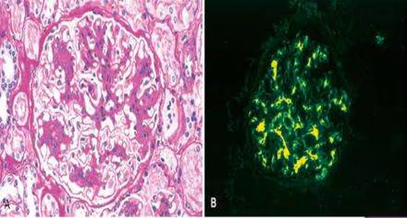 Renal biopsy histology of IgA nephropathy with mesangial proliferation and immunofluorescence showing IgA deposition