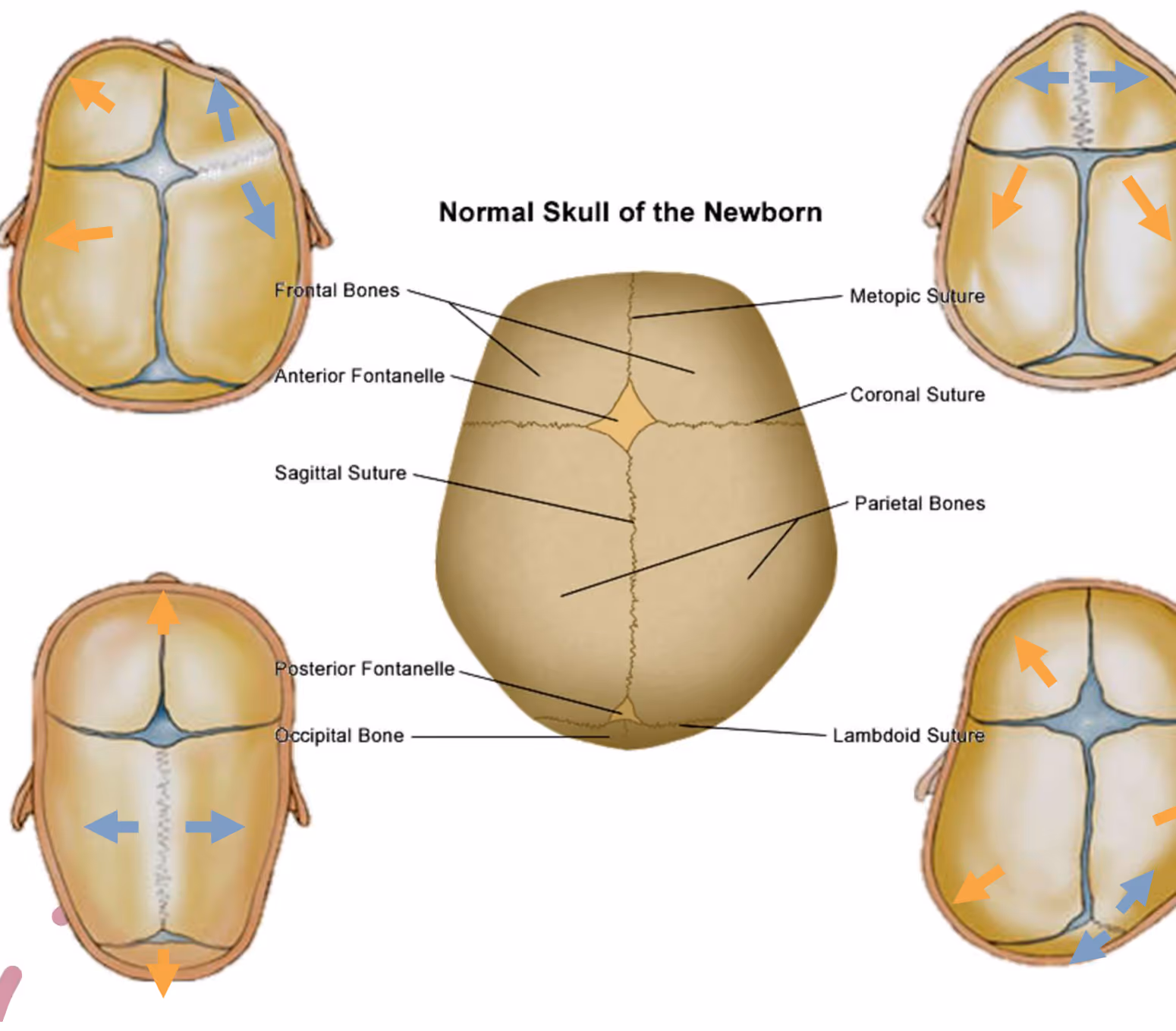 Diagram showing that craniosynostosis limits skull growth perpendicular to the fused suture and causes compensatory overgrowth at the open sutures, illustrated with directional arrows around four skull views.
