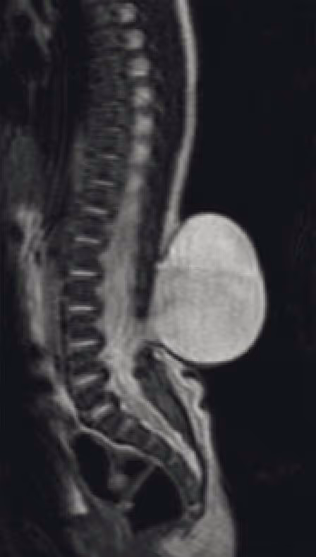 Sagittal MRI of the lumbosacral spine showing a meningocele. A rounded, fluid-filled sac herniates posteriorly through a bony defect in the lower spine, without spinal cord tissue extending into the sac.