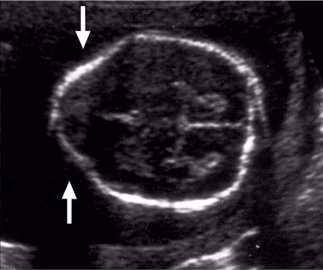 Axial prenatal ultrasound of a fetal head showing the lemon sign. White arrows mark inward scalloping of the frontal bones, giving the skull a pointed, lemon-shaped contour associated with open neural tube defect.