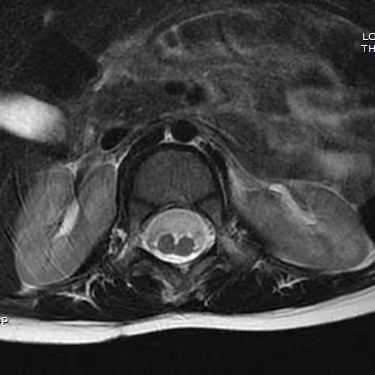 Axial MRI of the spine in a split cord malformation. The spinal cord is divided into two separate hemicords within the spinal canal at this level.