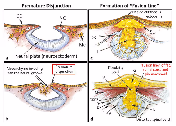 Four-panel illustration of spinal lipoma formation. Panels a and b show premature disjunction of cutaneous ectoderm from neural ectoderm with mesenchyme invading the open neural groove. Panels c and d show the resulting fibrofatty stalk and lipoma fused to a distorted spinal cord along a fusion line of fat, cord, and pia-arachnoid.