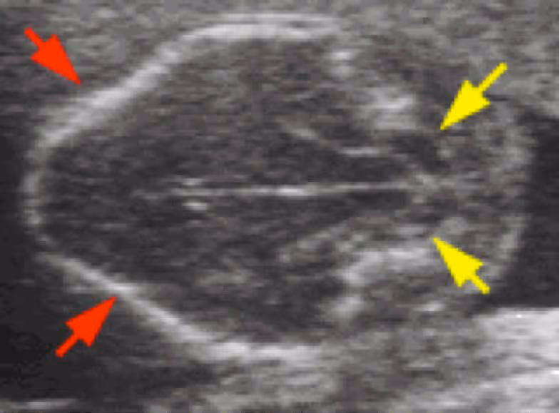 Axial prenatal ultrasound of a fetal head showing the banana sign. Red arrows mark the frontal scalloping and yellow arrows mark the cerebellum curved anteriorly around the brainstem, indicating hindbrain herniation in an open neural tube defect.