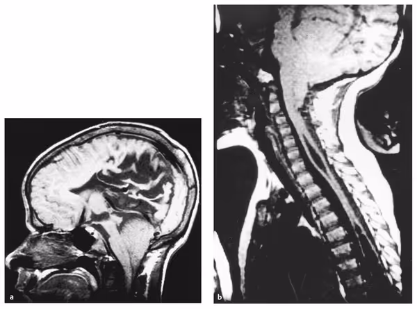 Sagittal MRI of the brain and cervical spine in Chiari II malformation. The images show a small posterior fossa with downward herniation of the cerebellar vermis, brainstem, and fourth ventricle through the foramen magnum into the upper cervical canal.