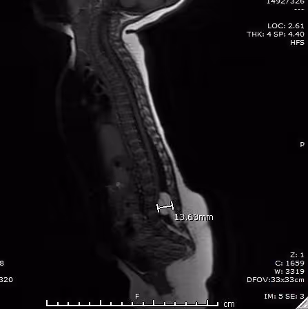 Sagittal MRI of the spine showing a spinal lipoma. A region of fatty signal is associated with the lower spinal cord, with an on-screen measurement of approximately 13.6 millimeters.
