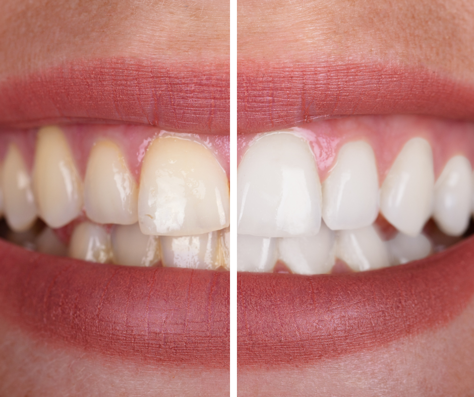 Teeth whitening results at Spring Texas dental office