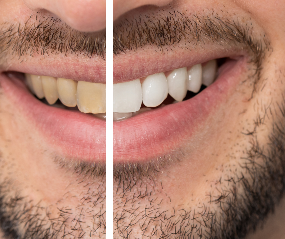 Bright white smile after teeth whitening at The Smile Designer