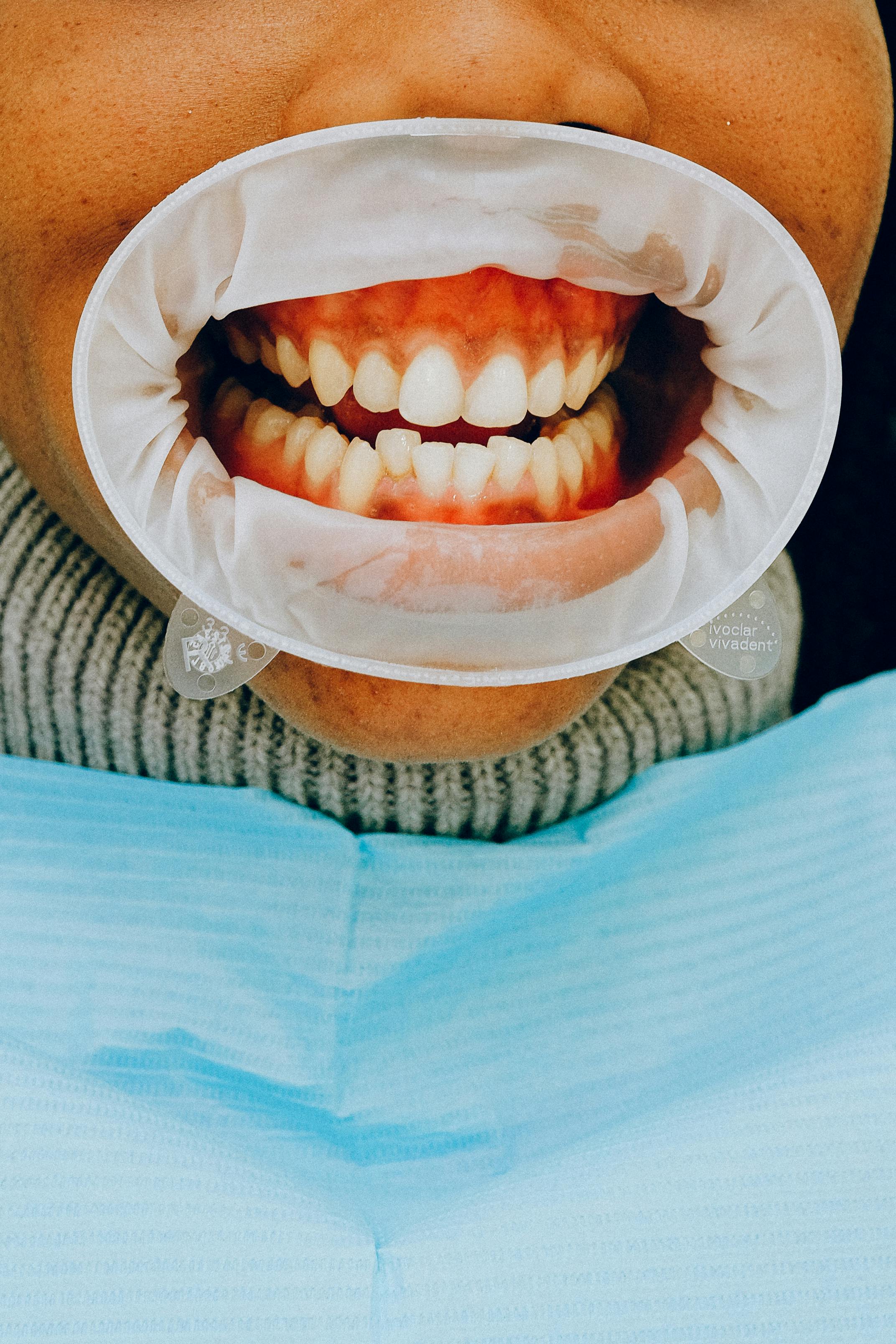Custom TMJ splint treatment at Spring TX dentist