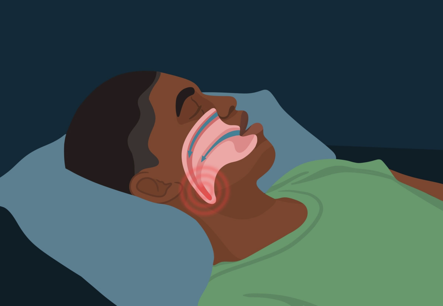 What is Sleep Apnea?