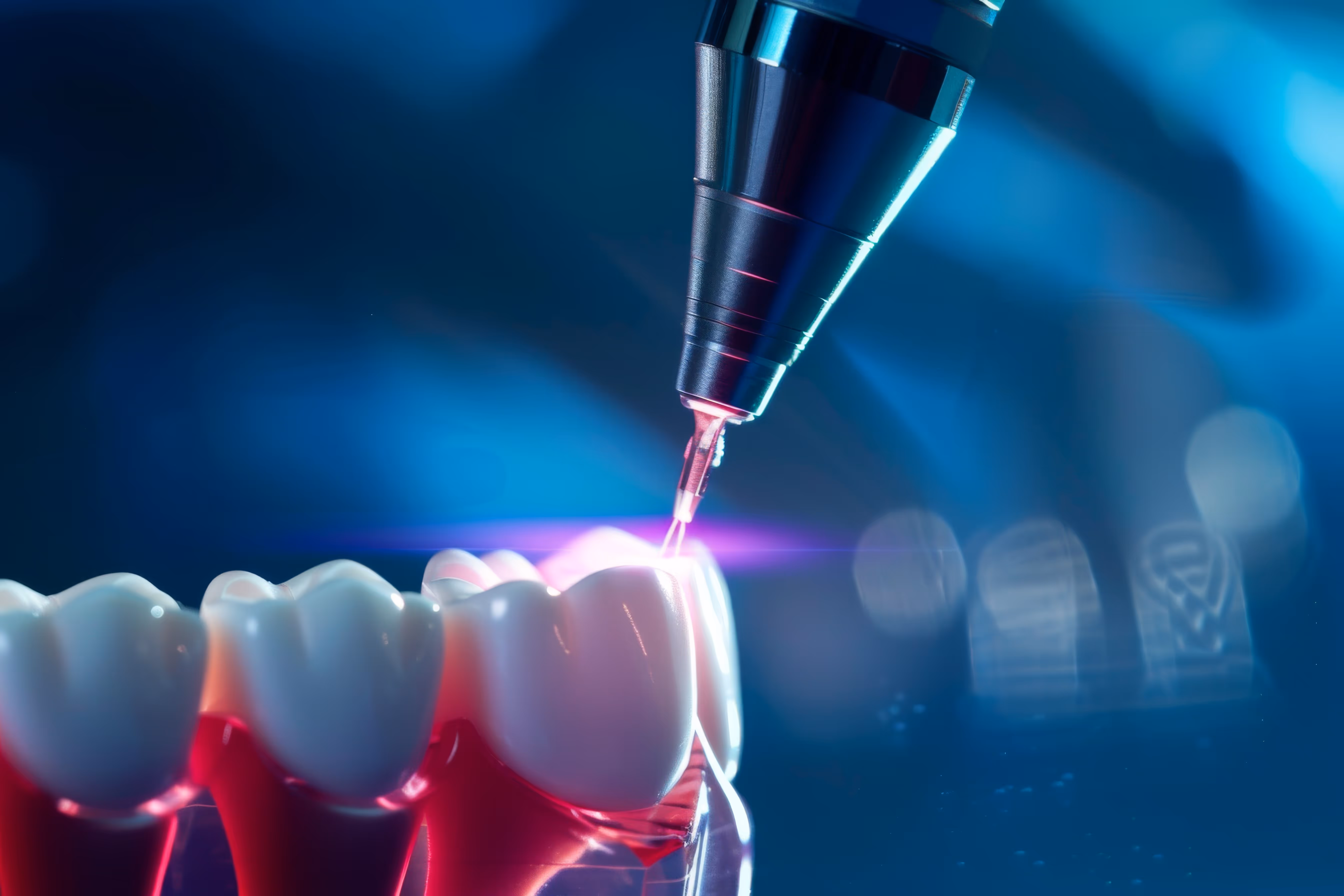 Laser working on a tooth in Clearwater, FL