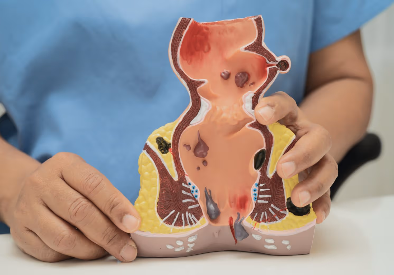 Explanation of hemorrhoids and discreet treatment options for pain relief in Los Angeles .