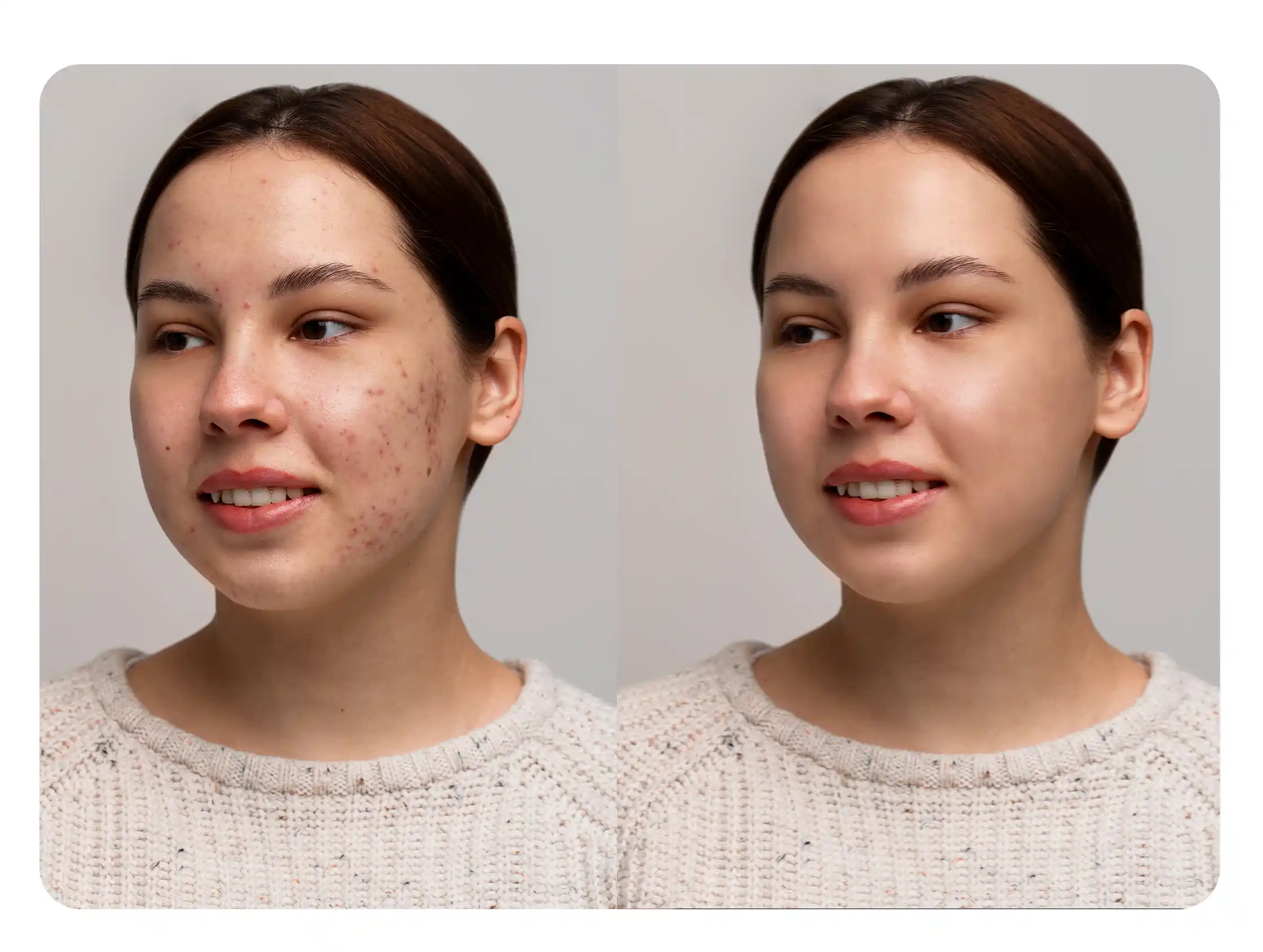 face blemish remover