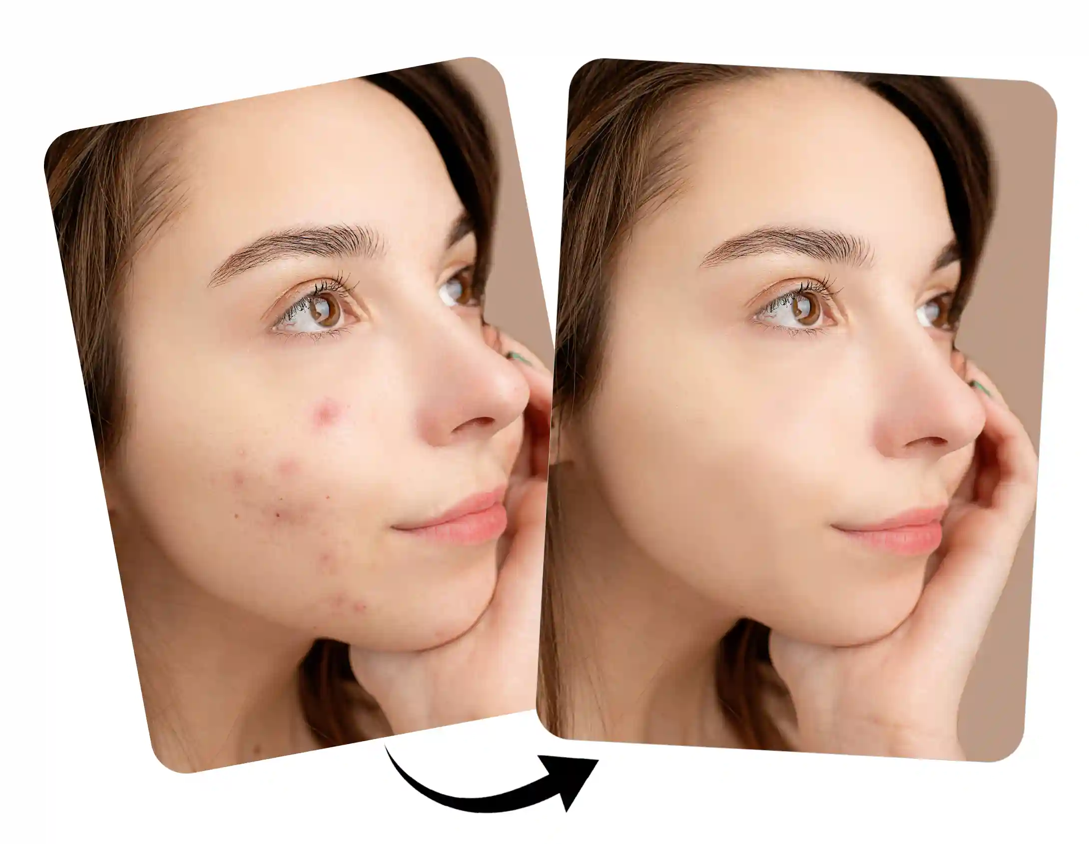 free blemish remover app
