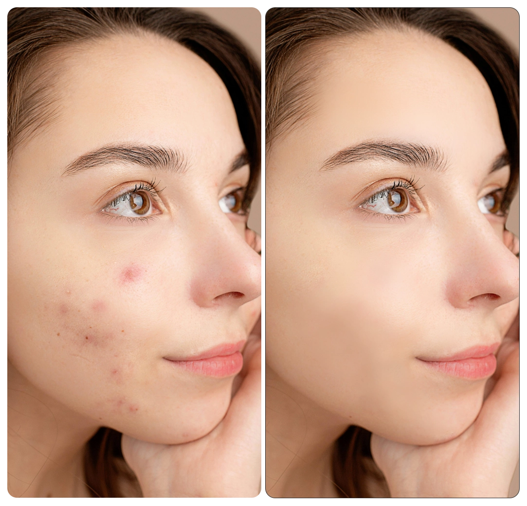 face blemish remover