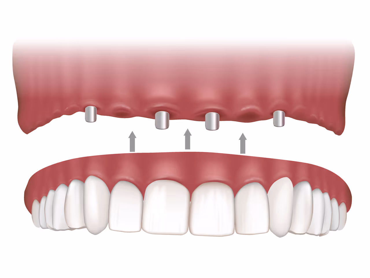 Implant Supported Dentures