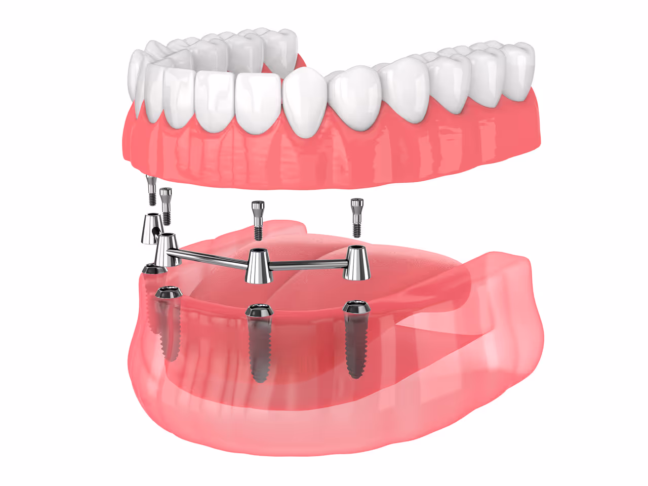 Implant Overdentures (Snap On Smiles)