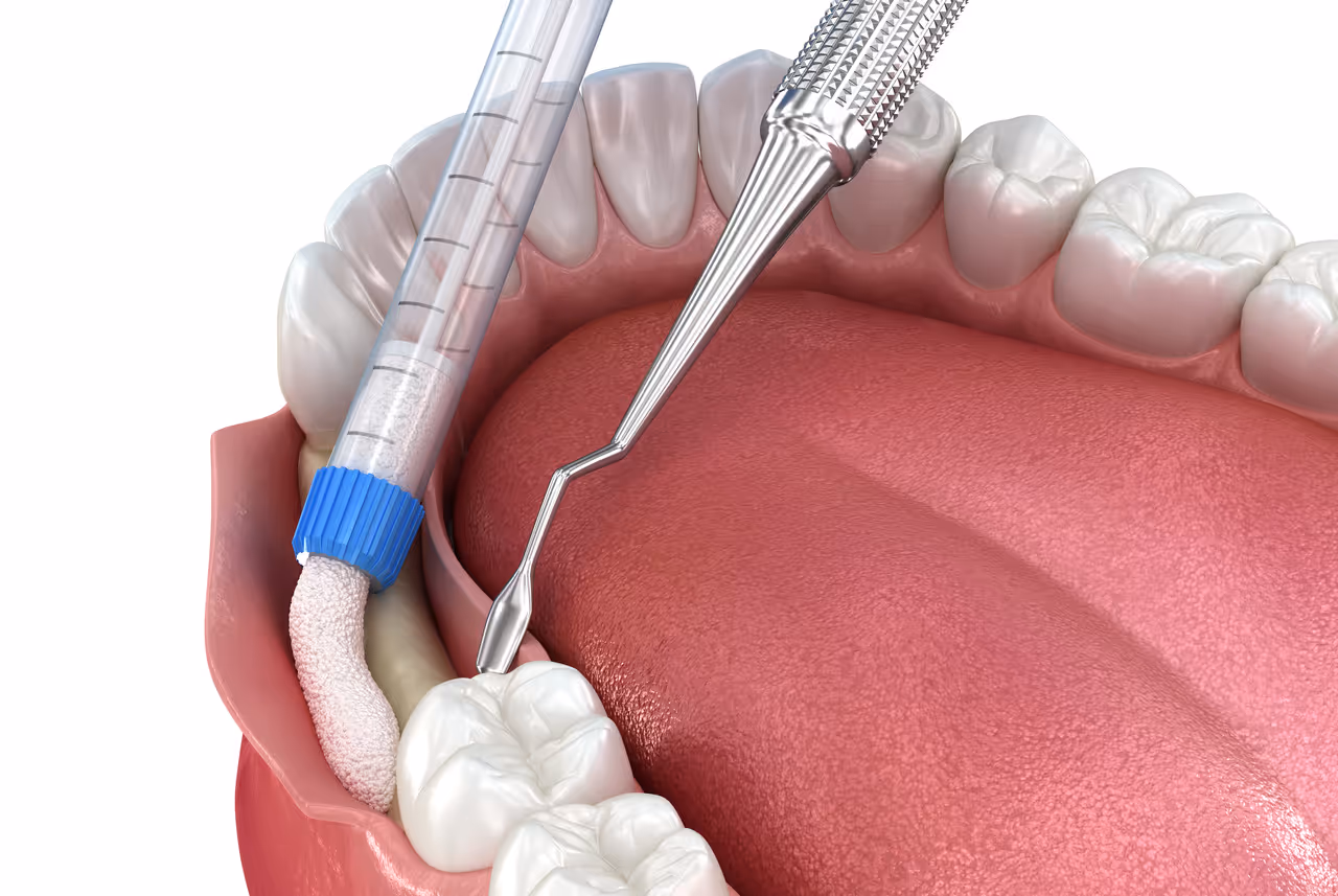 Bone Grafting