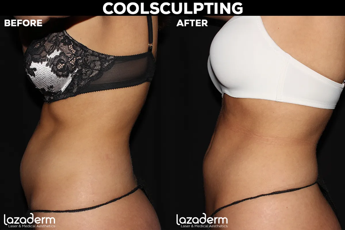 CoolSculpting Before and After