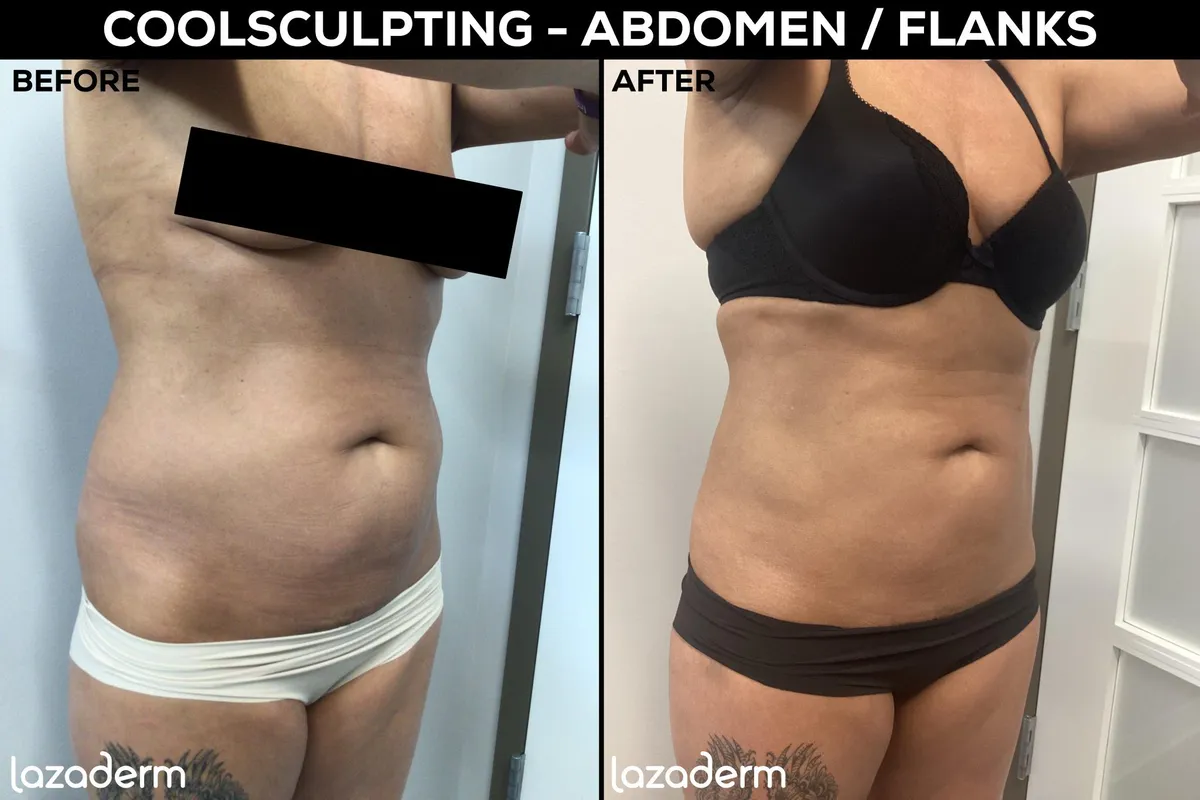 Abdominal and Flanks CoolSculpting Before and After