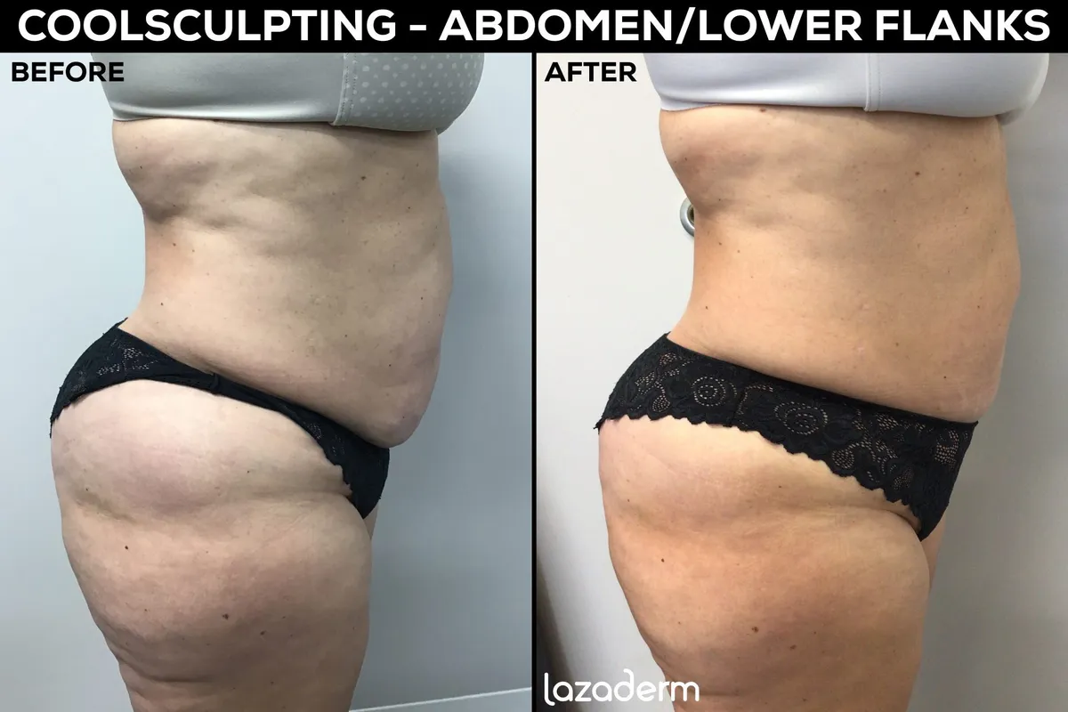 Abdominal CoolSculpting Before and After