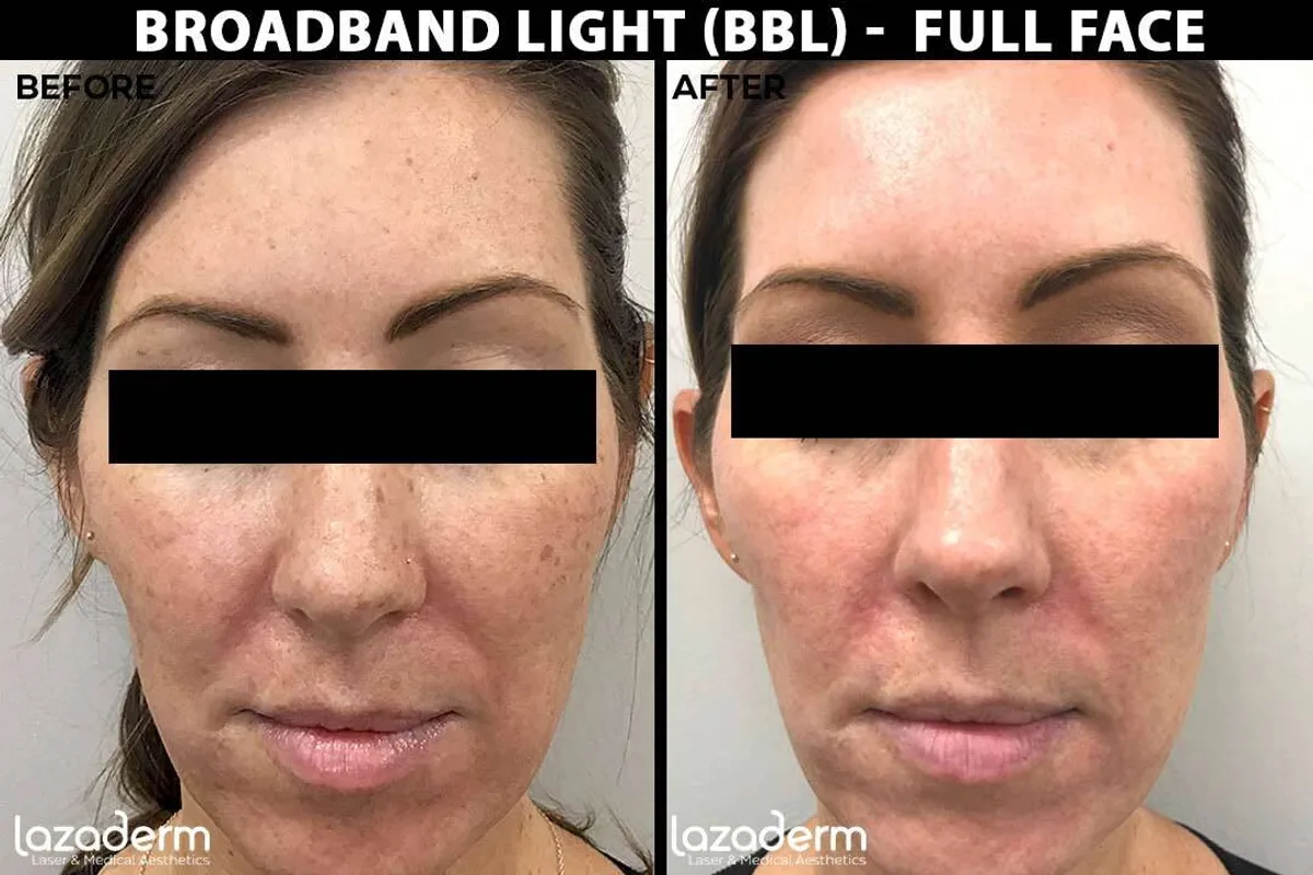 Broadband Light (BBL) Full Face Before & After