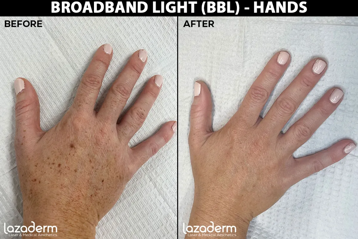 Broadband Light (BBL) Hands Before & After