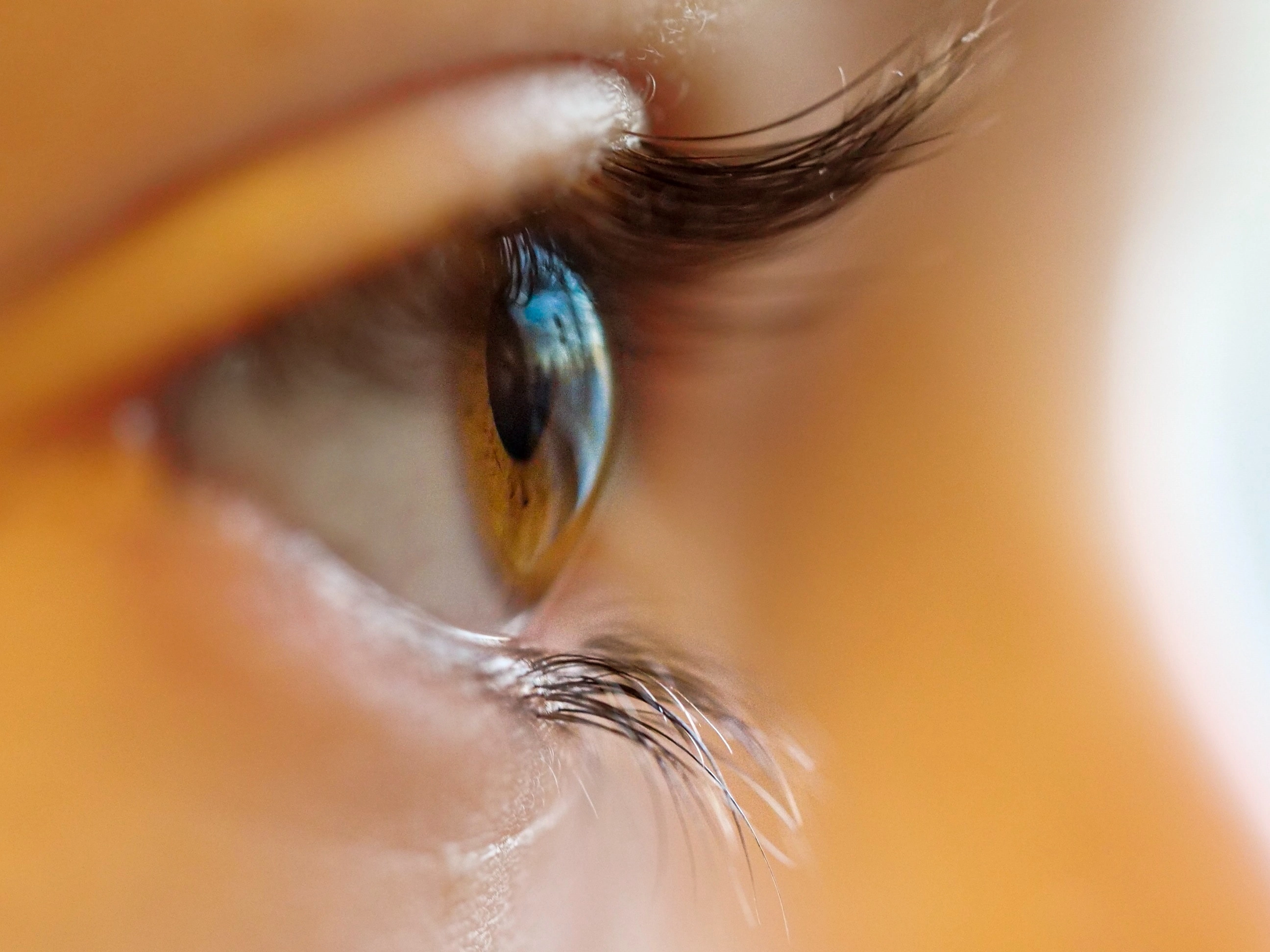 Close-up side profile of an eye showing cone-shaped cornea, characteristic of keratoconus