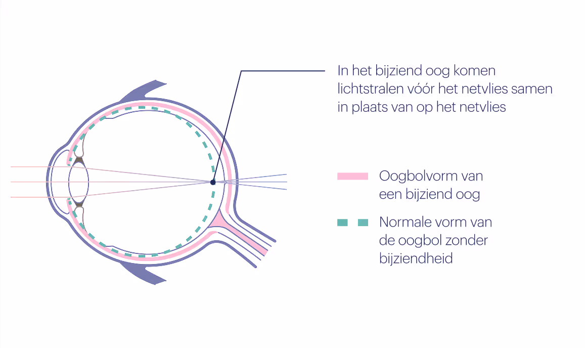 In het bijziend oog komen lichtstralen vóór het netvlies samen in plaats van op het netvlies
