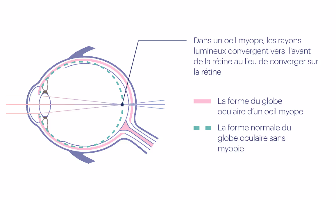 Dans un oeil myope, les rayons lumineux convergent vers
l'avant de la rétine au lieu de converger sur la rétine