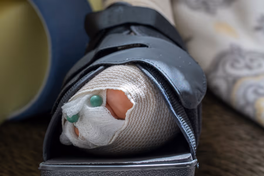 hammertoe surgery recovery in a boot