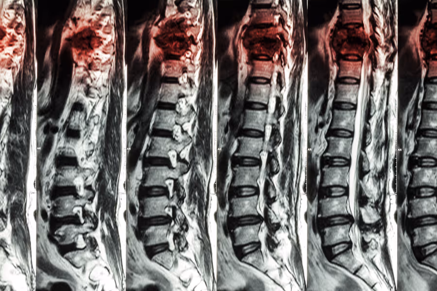 Xray of a spine fracture