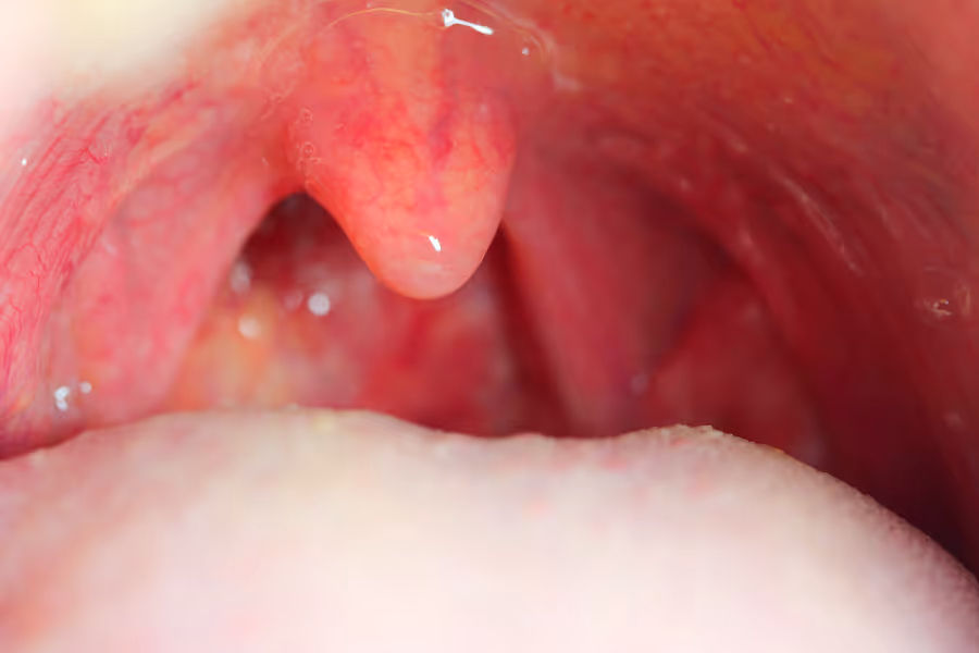 Closeup of infected tonsils