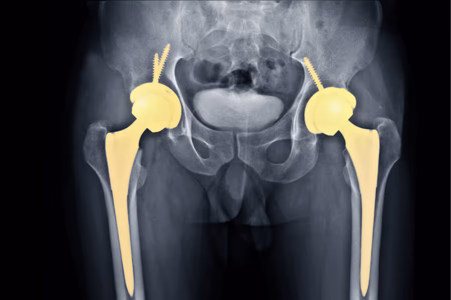 Xray visualization of double total hip replacement