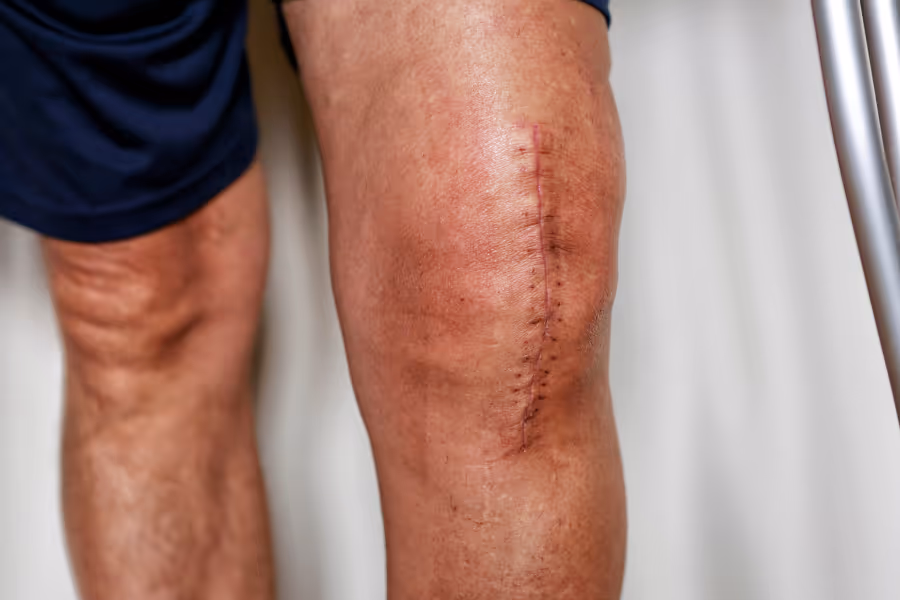 Knee replacement surgery scar several weeks after surgery