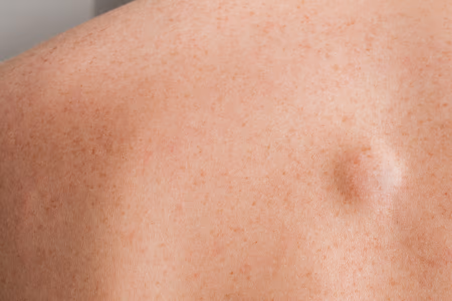 Visible lipoma on woman's back