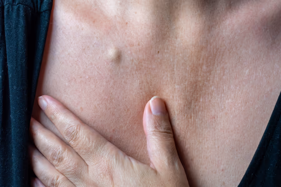 Woman with a visible cyst in her upper chest