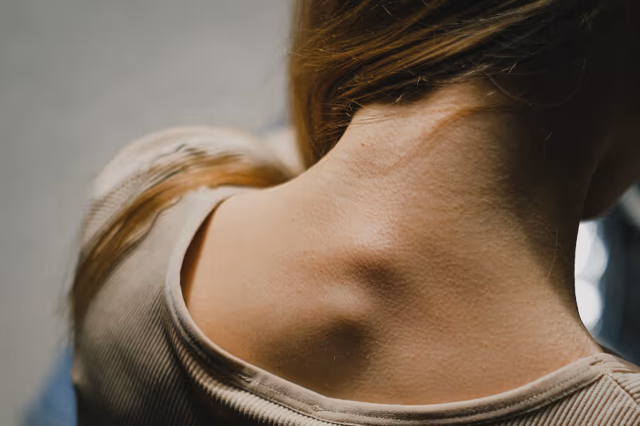 Cervical spine showing through skin